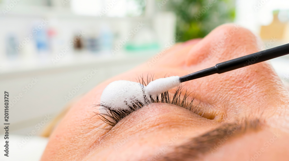 Cleaning foam on the eyelashes and lid margin